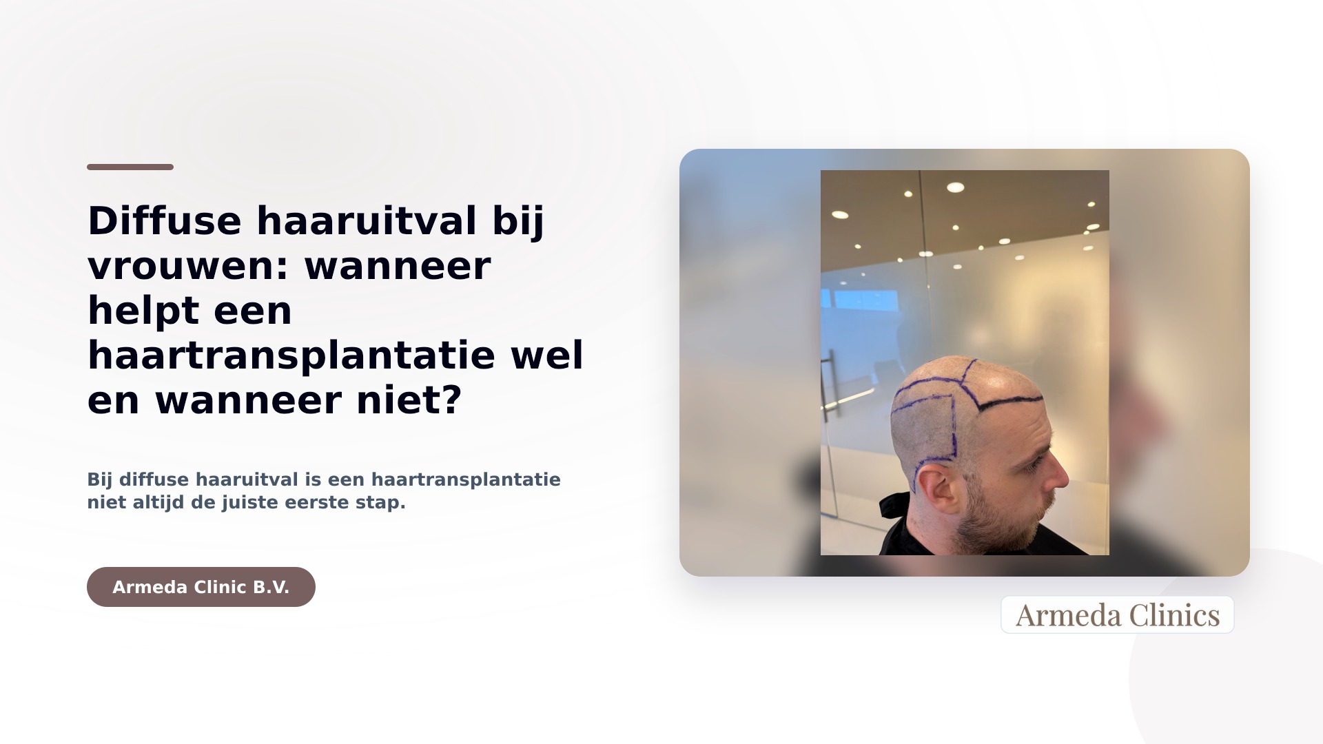 Diffuse haaruitval bij vrouwen: wanneer helpt een haartransplantatie wel en wanneer niet?