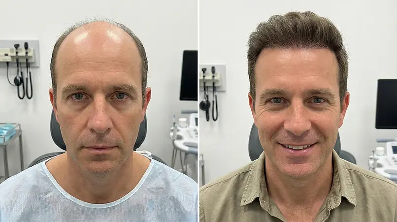 Armeda Clinics Eindhoven haartransplantatie before en after